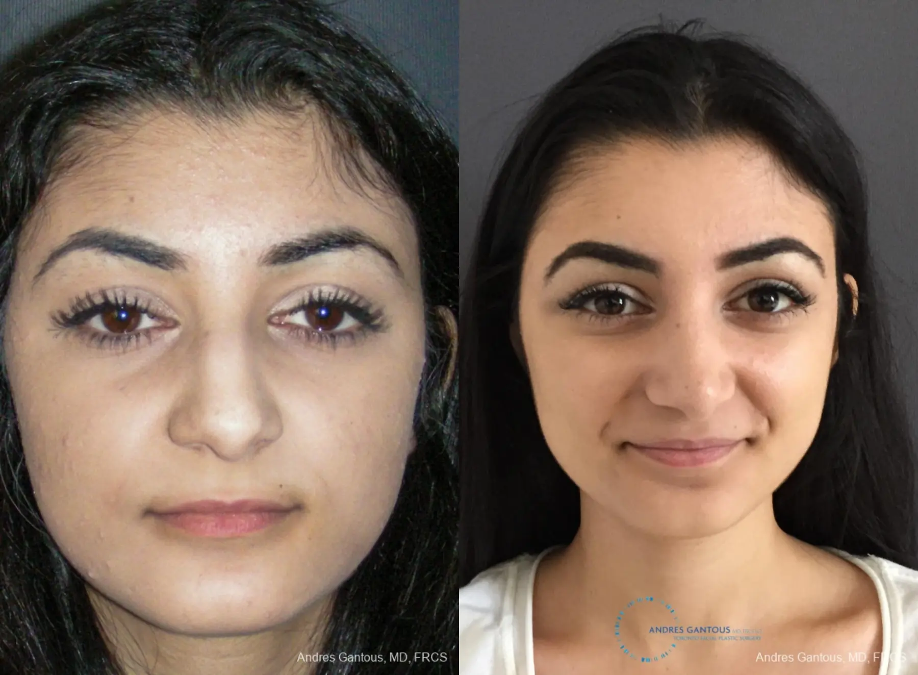 Rhinoplasty: Patient 85 - Before and After  