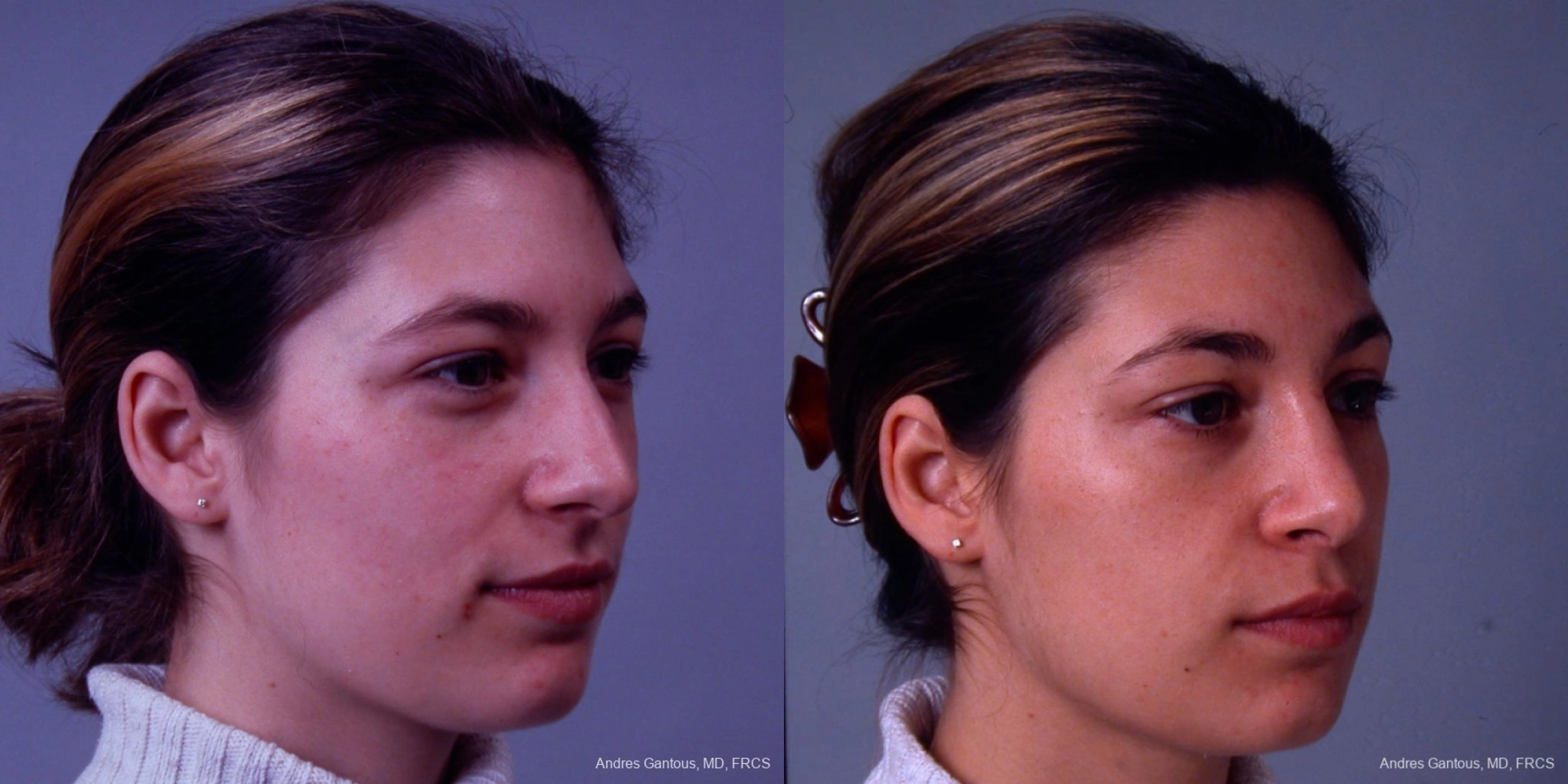 Rhinoplasty - Thumbnail 3