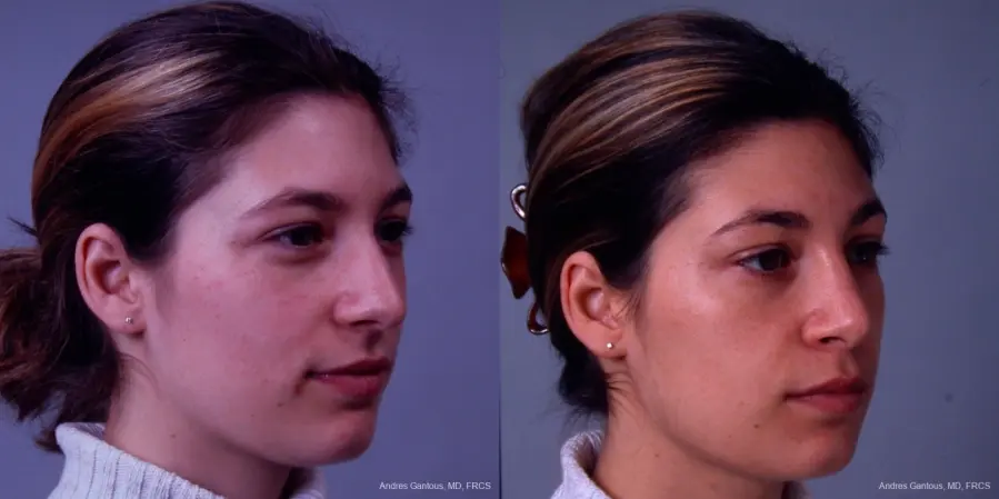 Rhinoplasty: Patient 32 - Before and After 3
