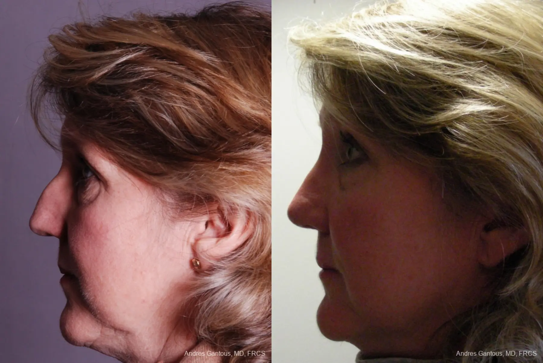 Rhinoplasty: Patient 18 - Before and After 4