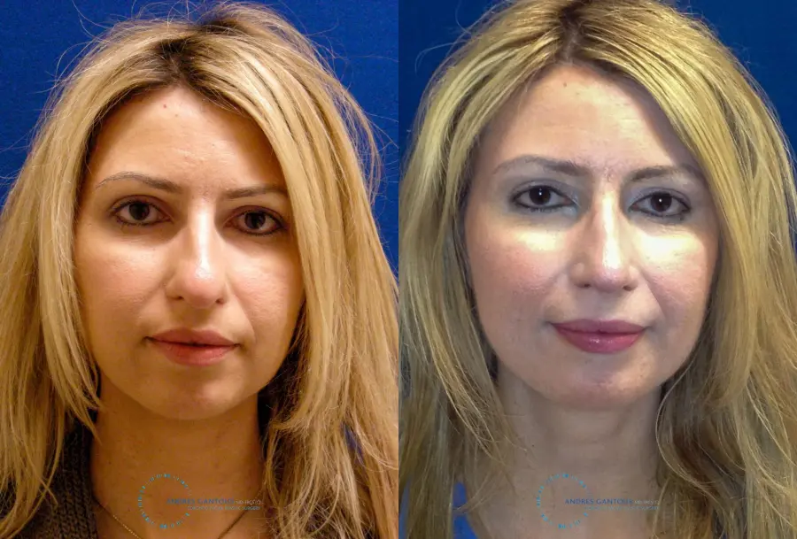 Rhinoplasty: Patient 74 - Before and After 1
