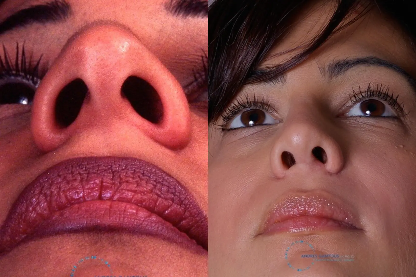 Rhinoplasty: Patient 31 - Before and After 2