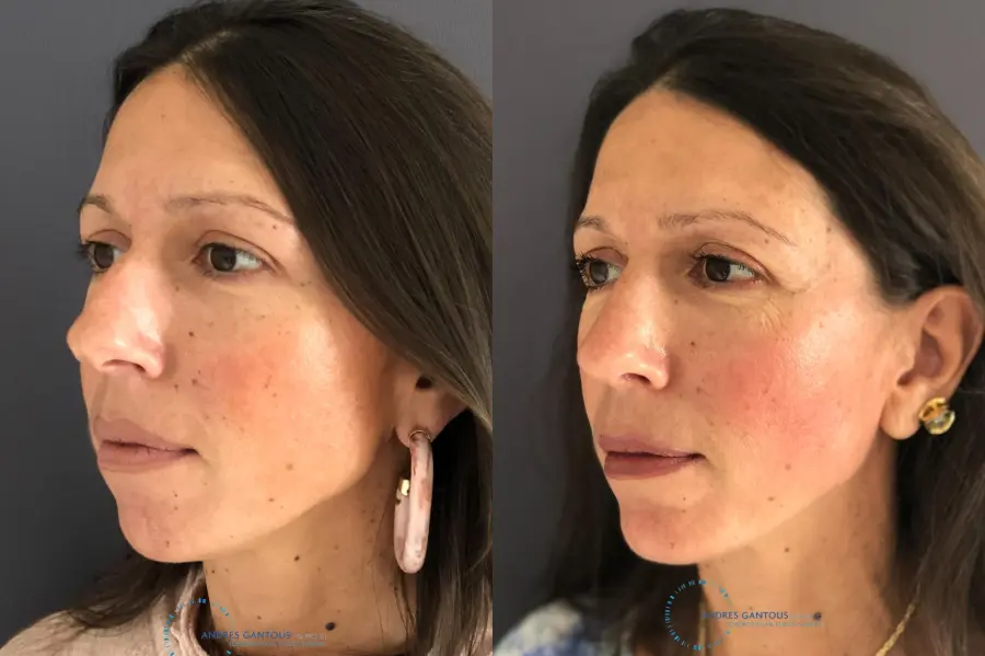 Rhinoplasty: Patient 8 - Before and After 3