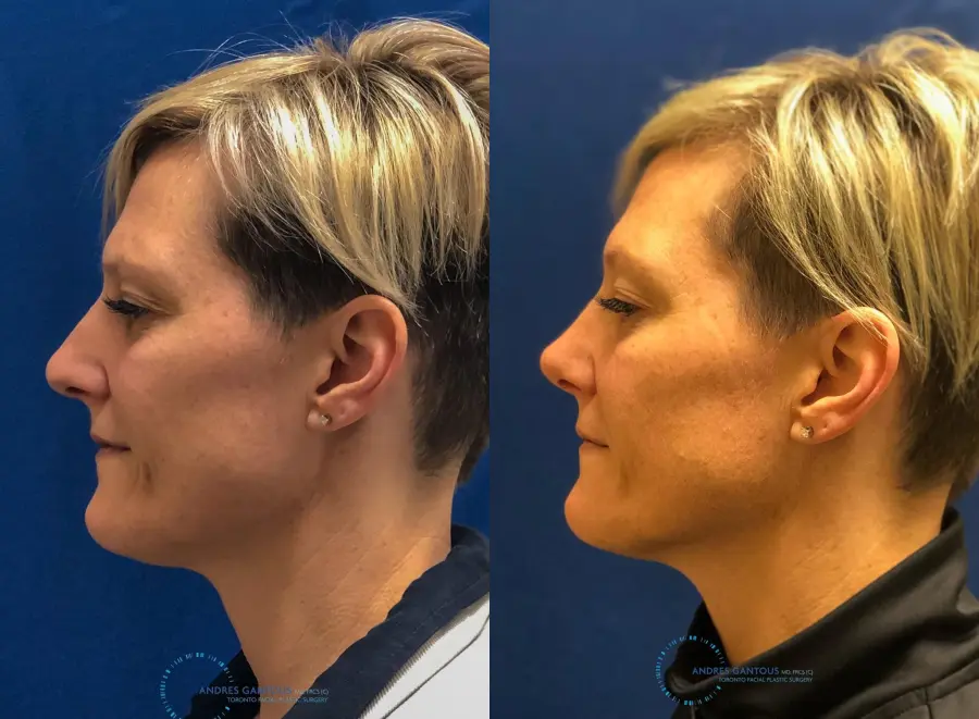 Rhinoplasty: Patient 68 - Before and After 6