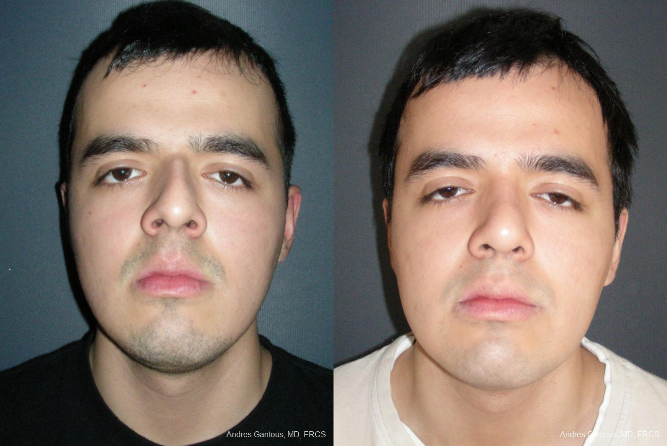 Nose Procedures - Case 11643