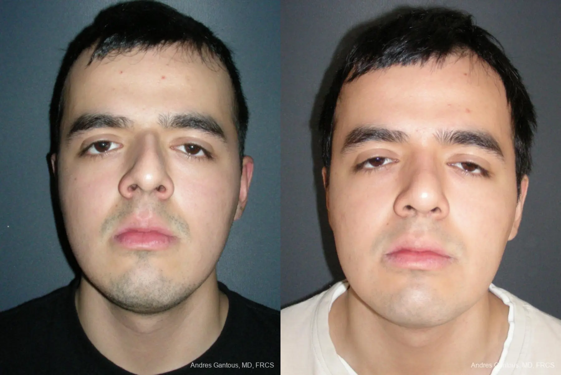 Rhinoplasty: Patient 54 - Before and After 1