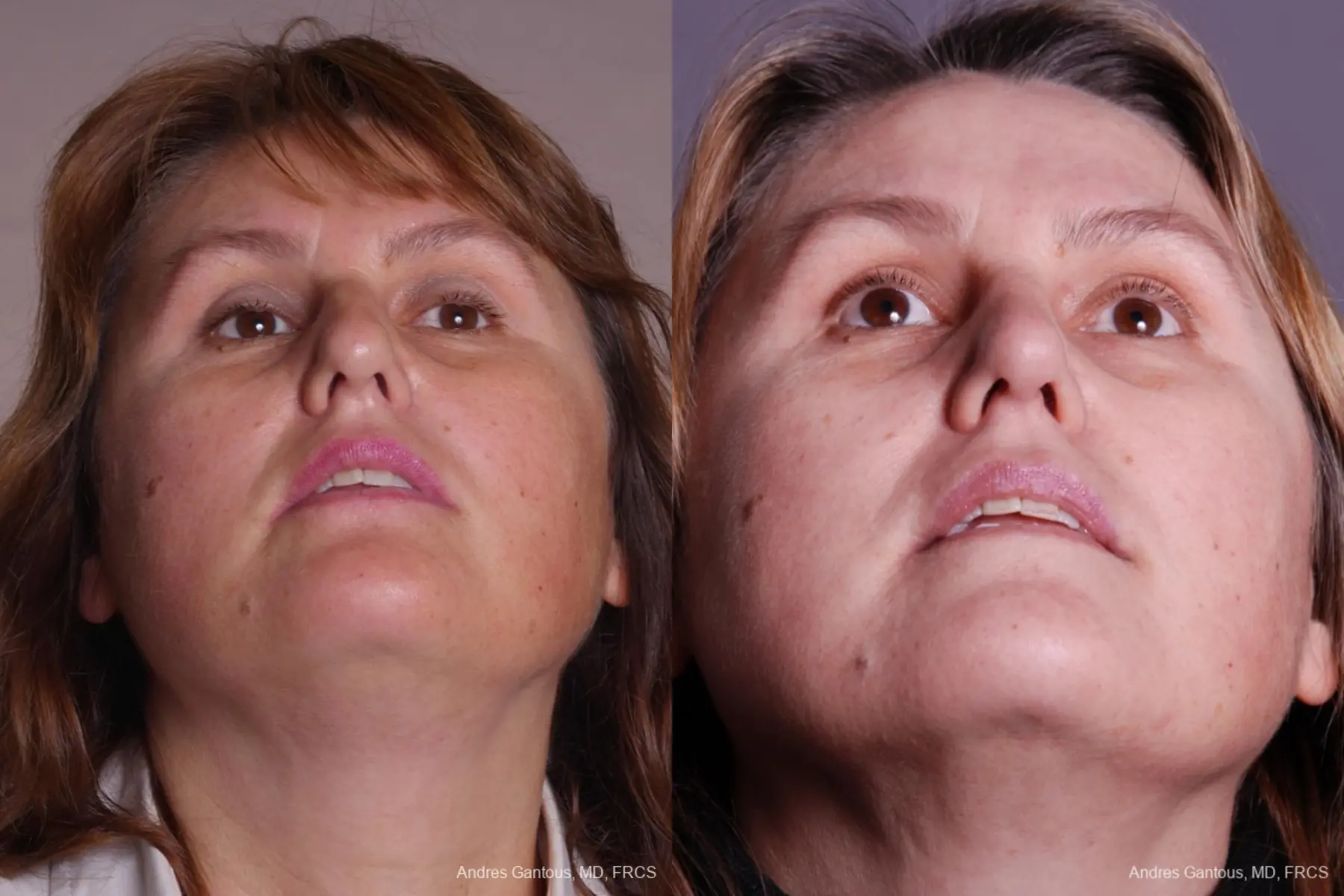 Rhinoplasty: Patient 40 - Before and After 6