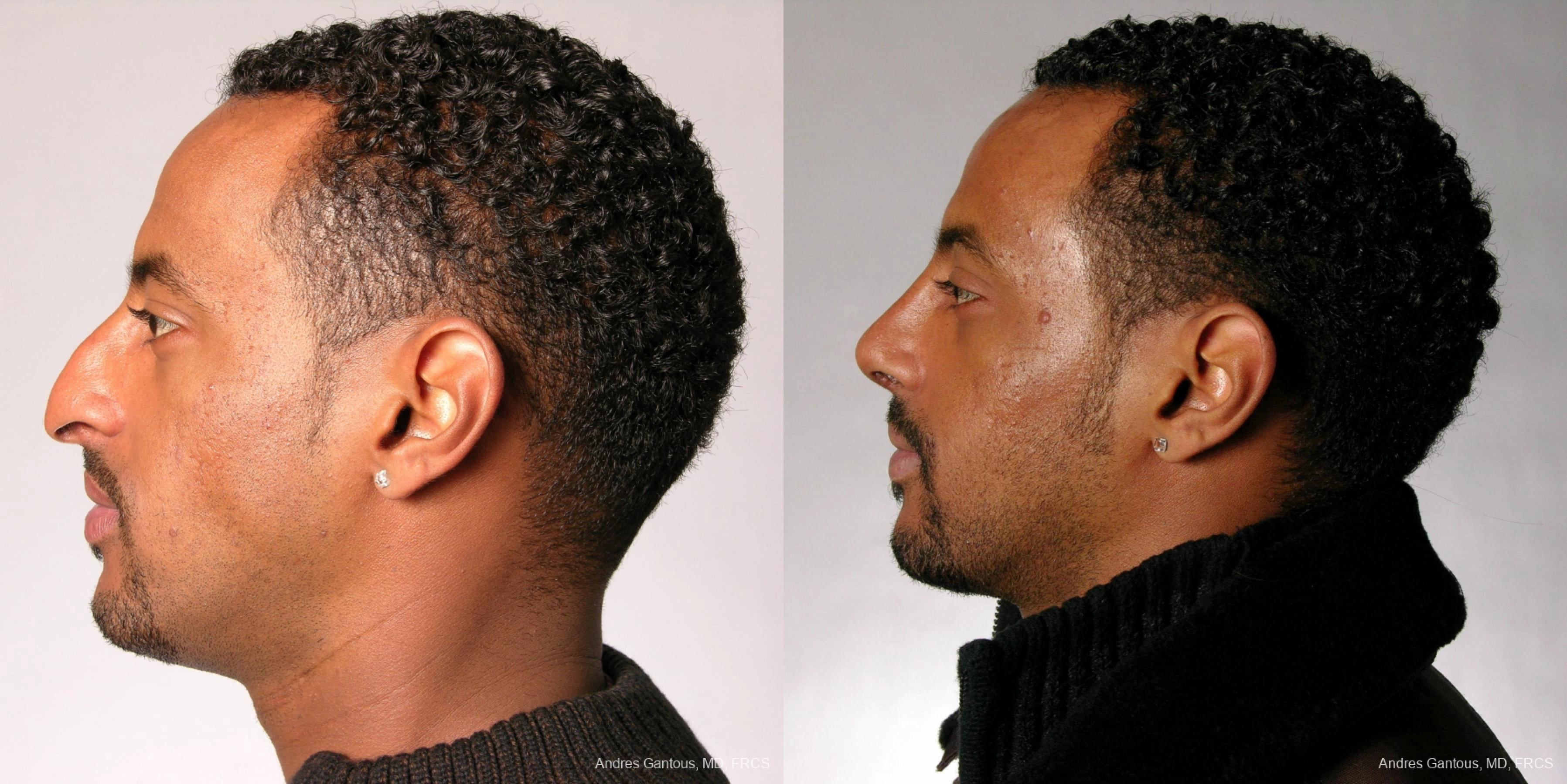 Rhinoplasty - Thumbnail 2