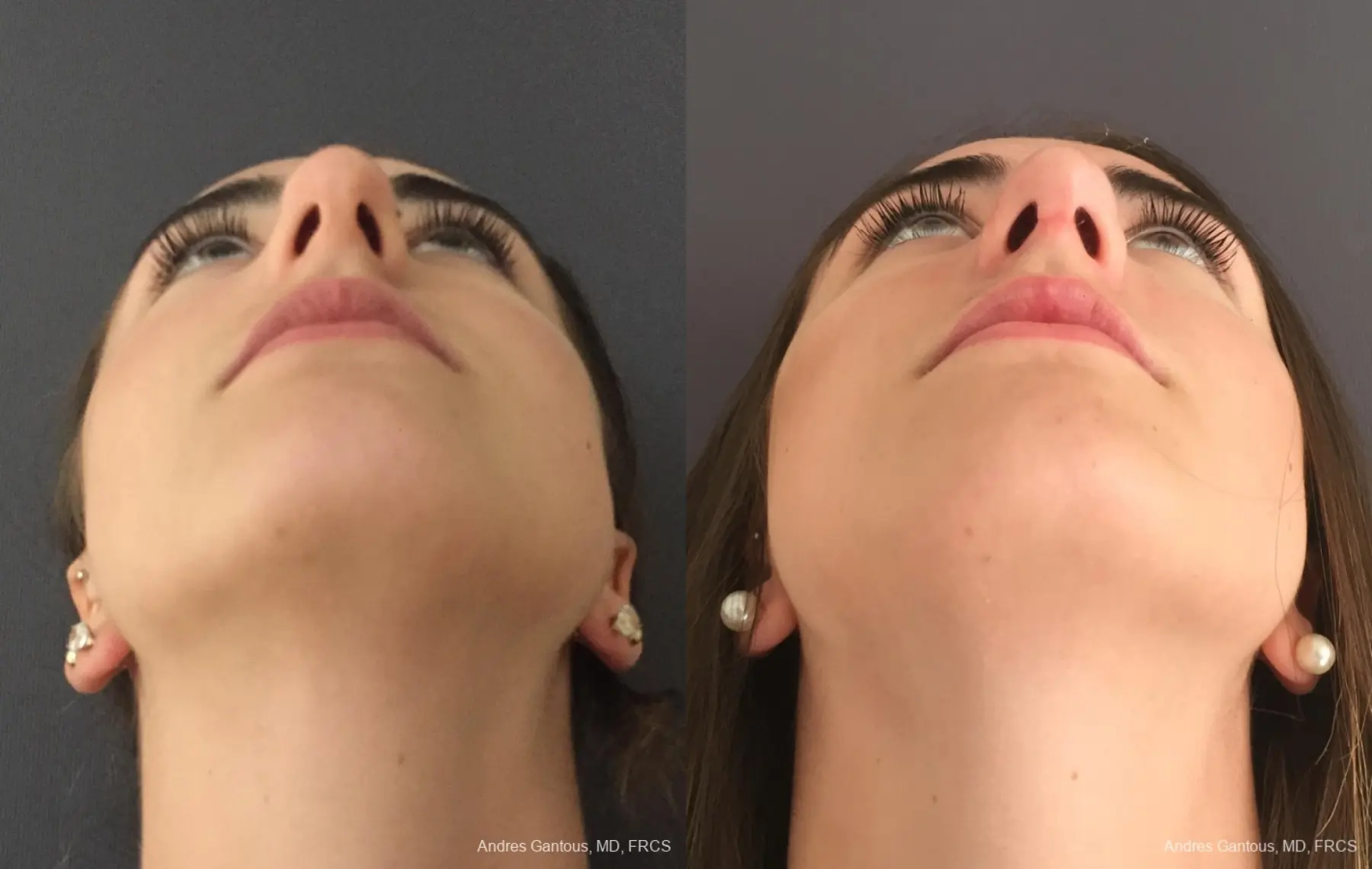 Rhinoplasty: Patient 95 - Before and After 2