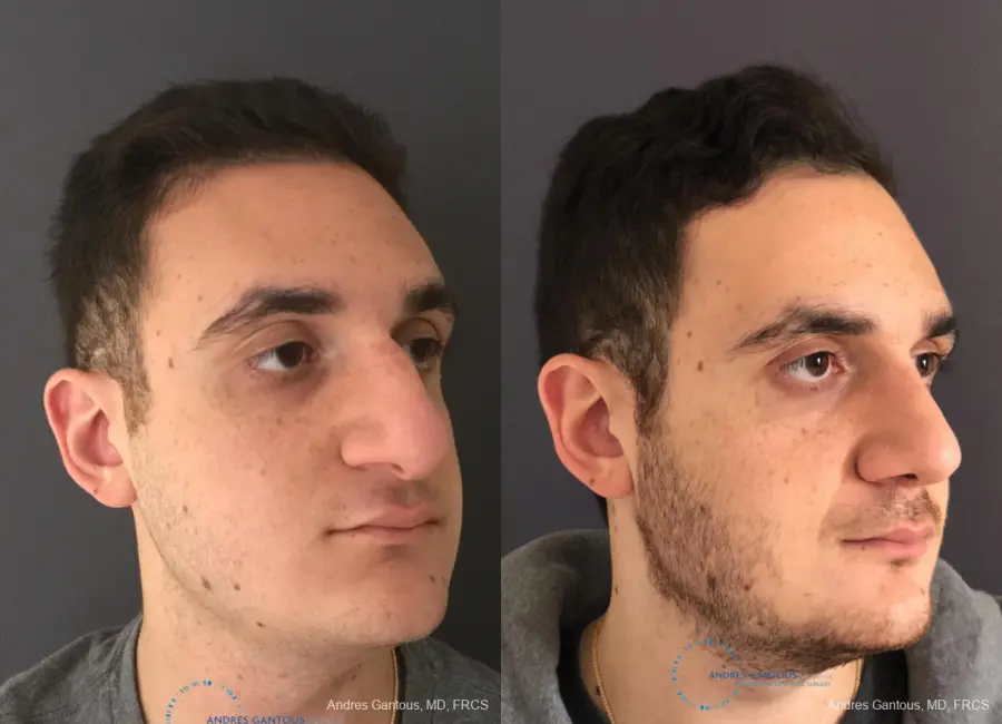Rhinoplasty: Patient 81 - Before and After 3