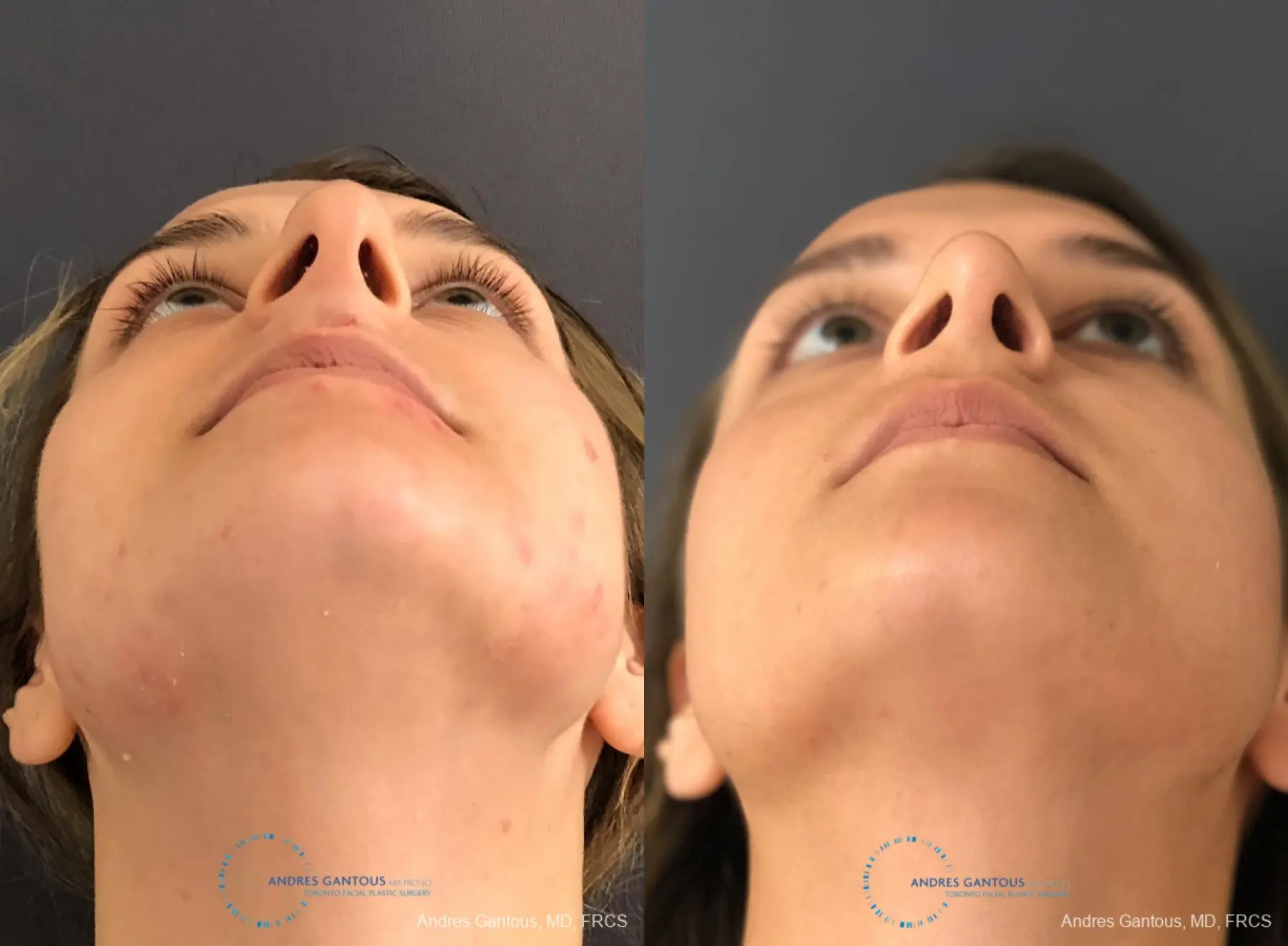 Rhinoplasty: Patient 86 - Before and After 2