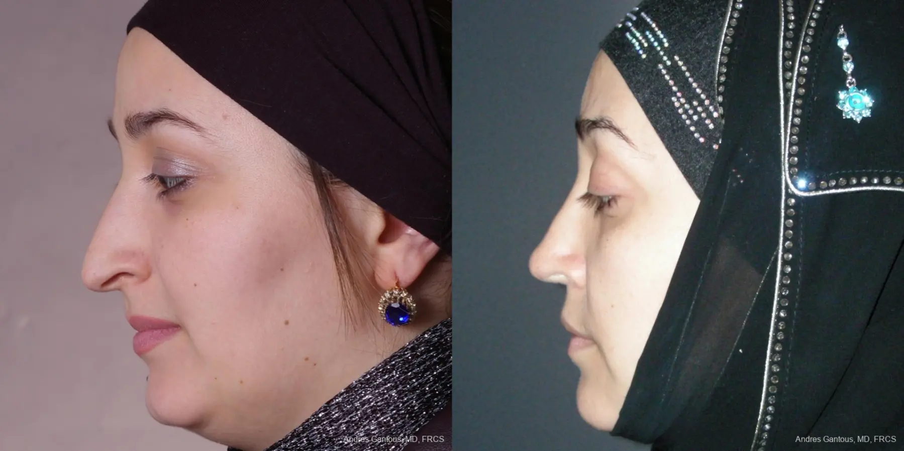 Rhinoplasty: Patient 51 - Before and After 5