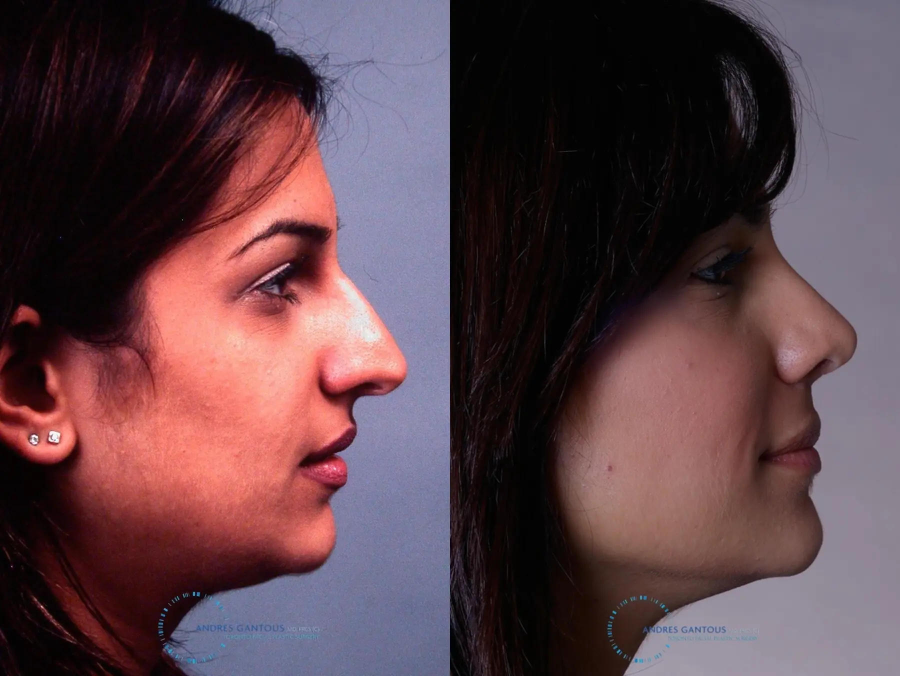 Rhinoplasty: Patient 31 - Before and After 3