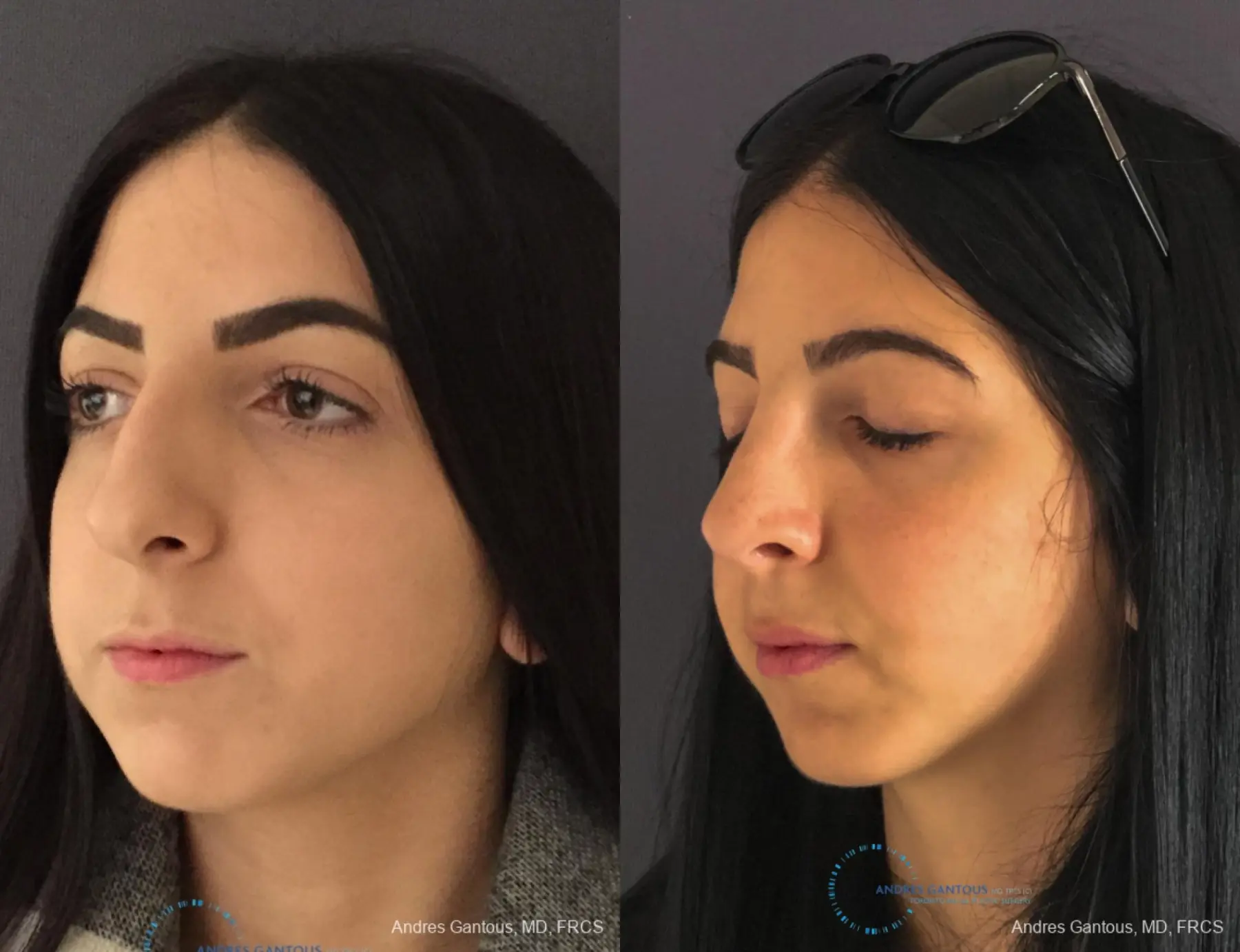 Rhinoplasty: Patient 83 - Before and After 4