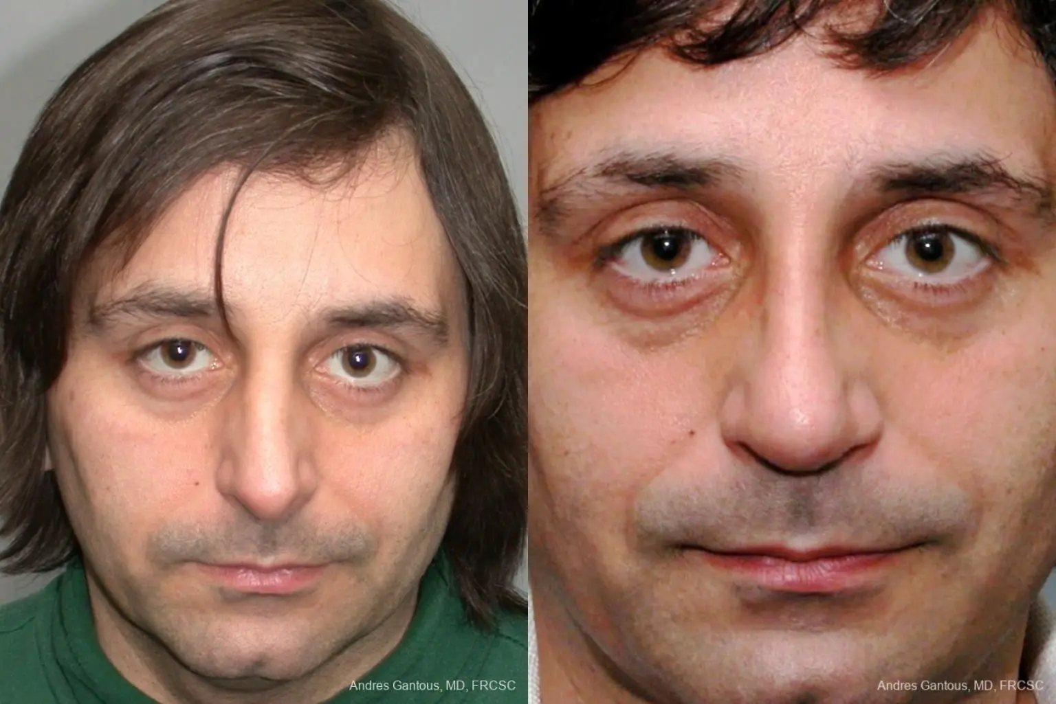 Rhinoplasty: Patient 17 - Before and After  