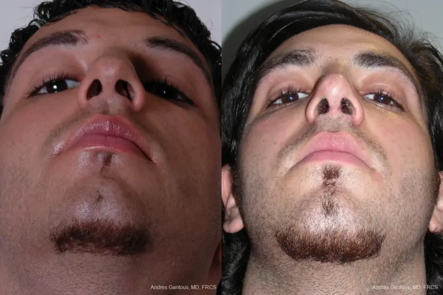 Rhinoplasty: Patient 12 - Before and After 4