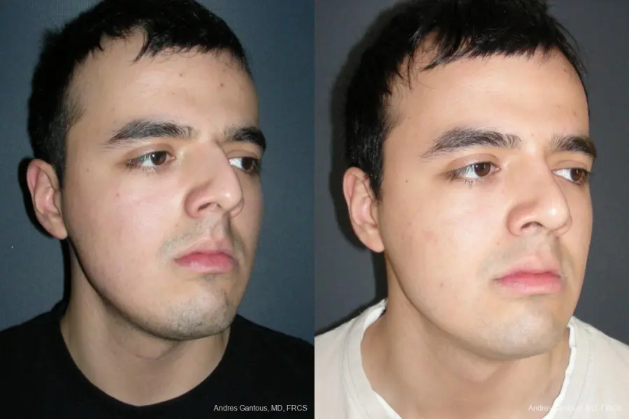Rhinoplasty: Patient 54 - Before and After 2
