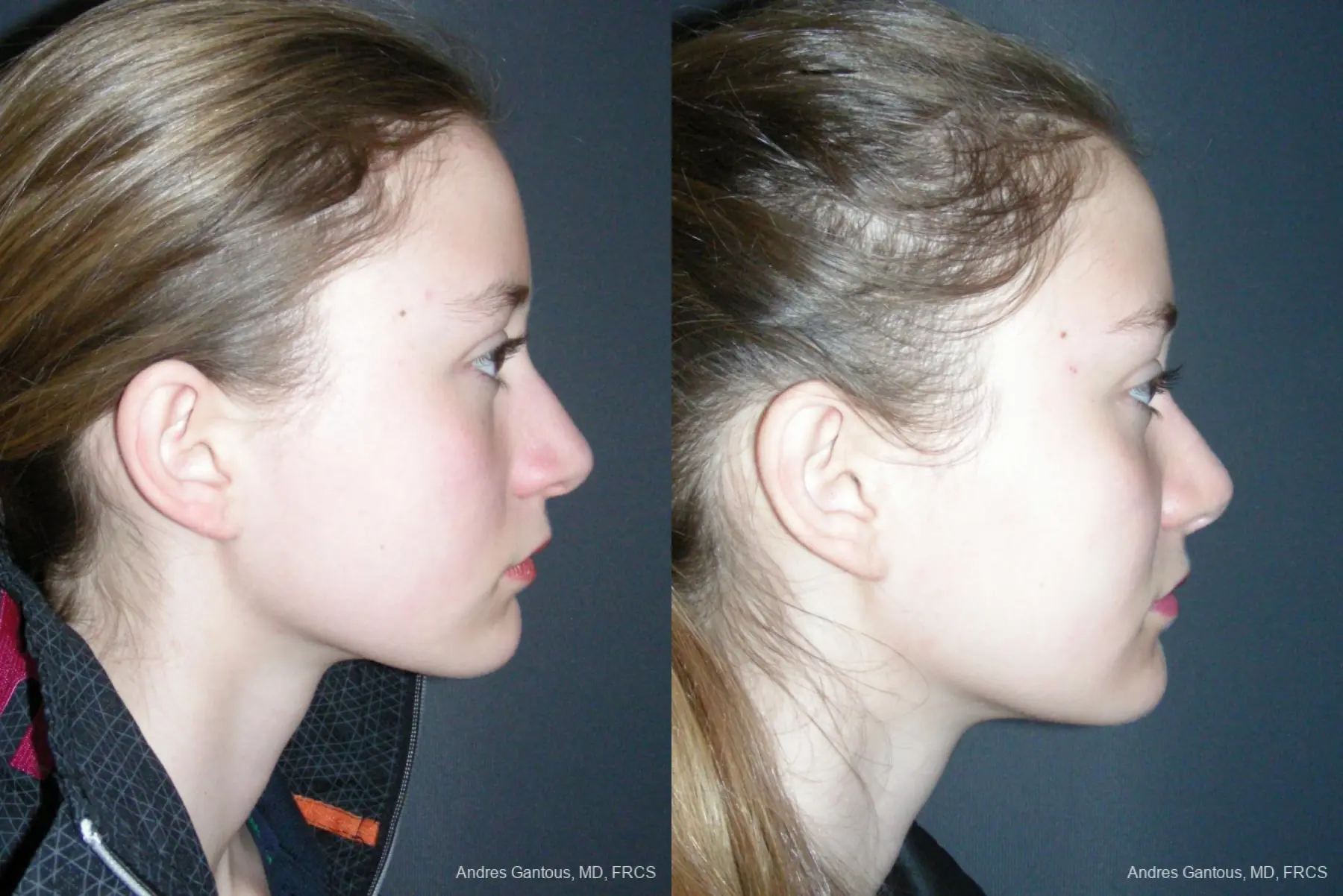 Rhinoplasty: Patient 55 - Before and After 3