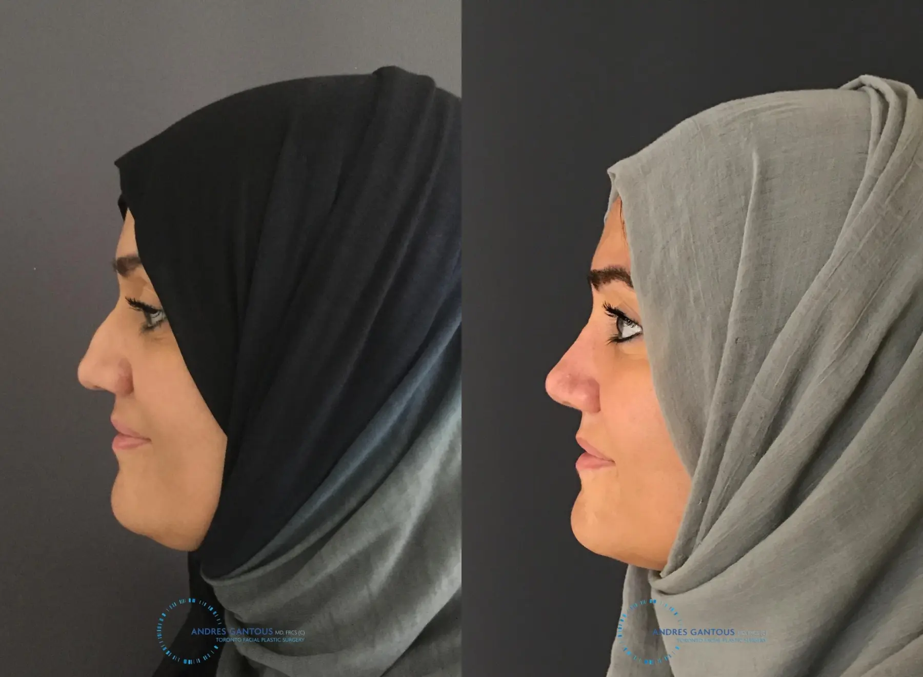 Rhinoplasty: Patient 5 - Before and After 5