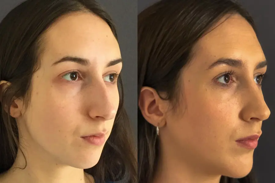 Rhinoplasty: Patient 7 - Before and After 4