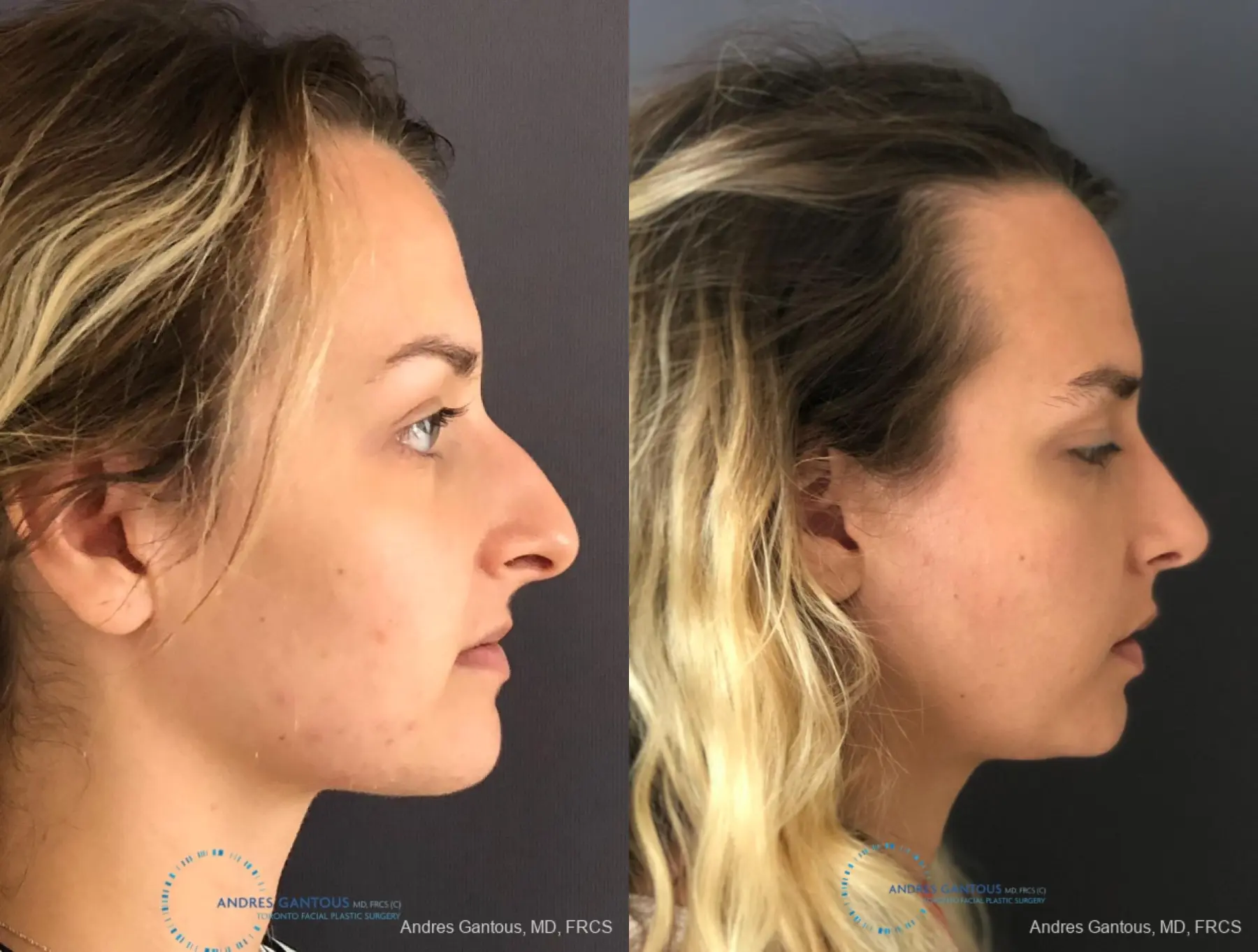 Rhinoplasty: Patient 86 - Before and After 5