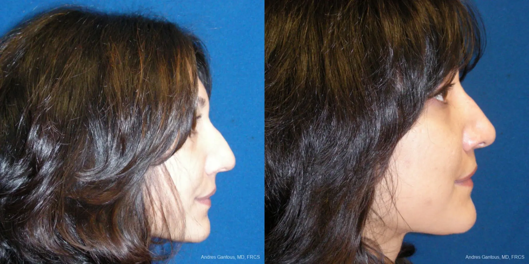 Rhinoplasty: Patient 42 - Before and After 5
