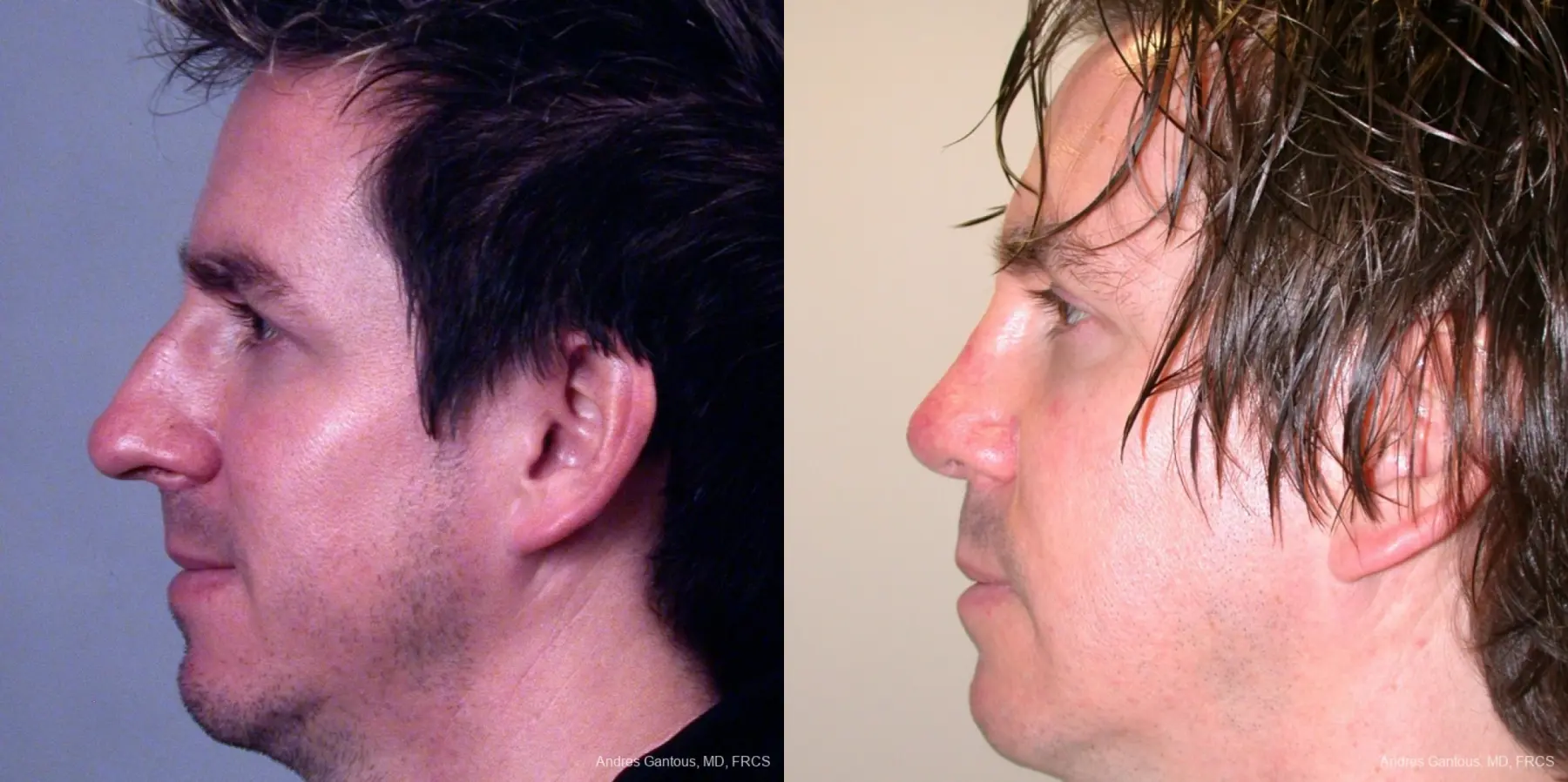 Rhinoplasty: Patient 39 - Before and After 5