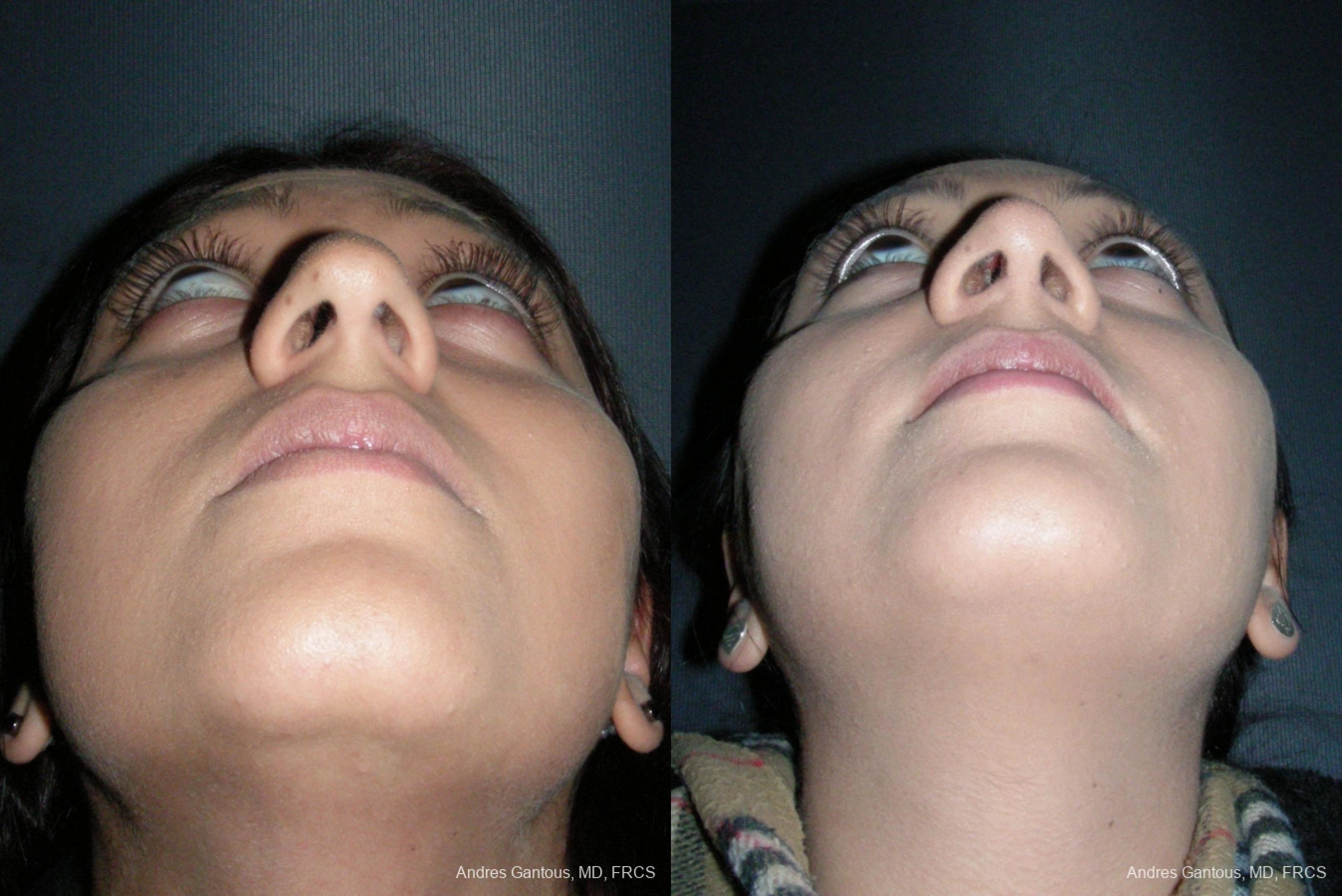 Rhinoplasty - Thumbnail 6