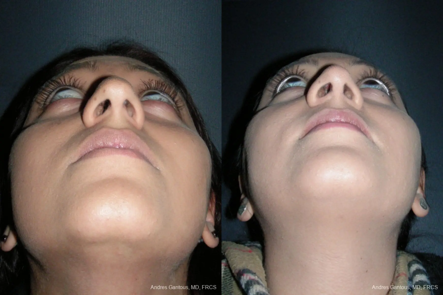 Rhinoplasty: Patient 45 - Before and After 6
