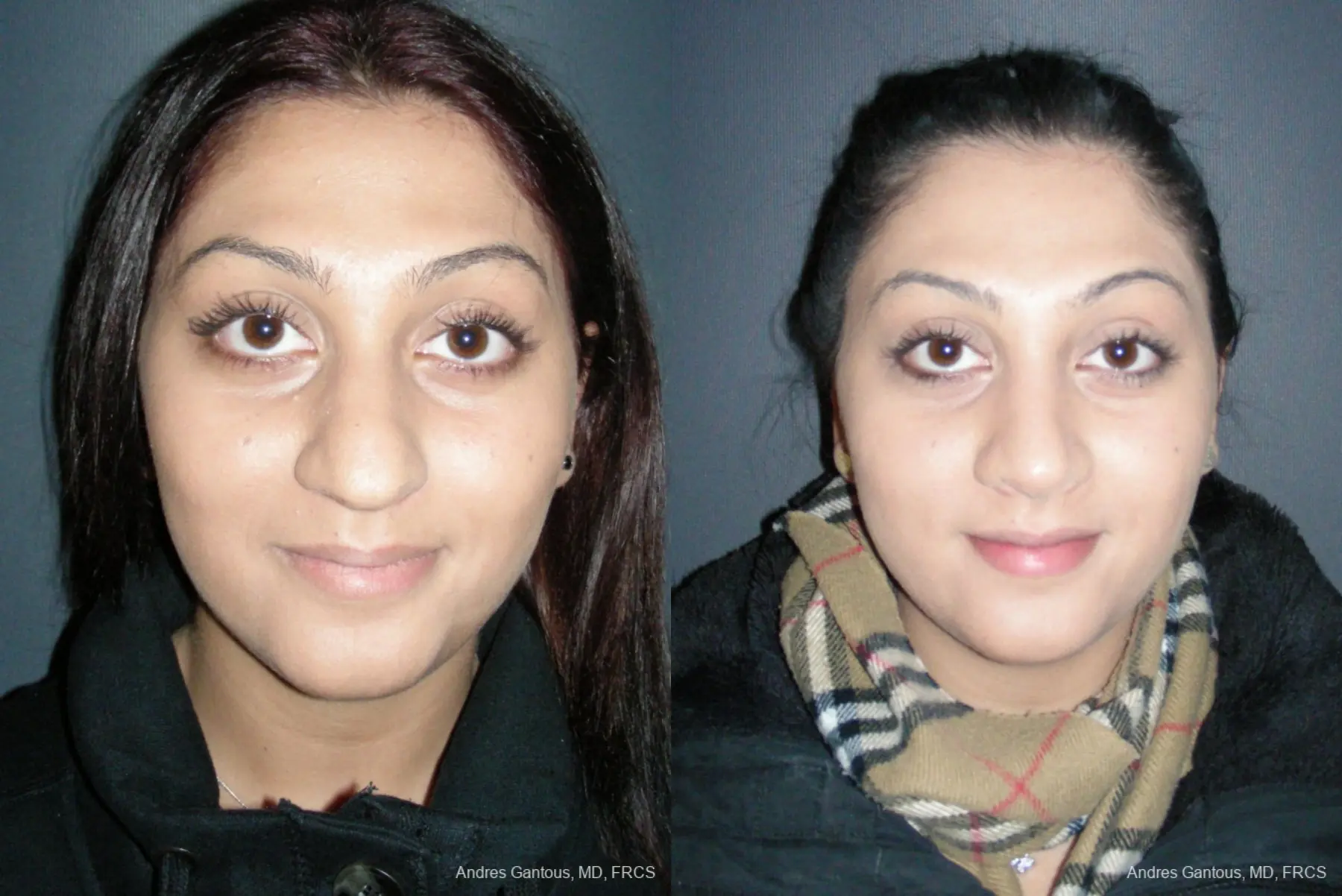 Rhinoplasty: Patient 45 - Before and After 1