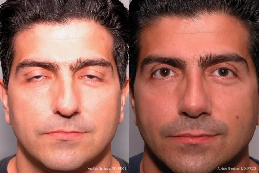 Rhinoplasty: Patient 24 - Before and After 1