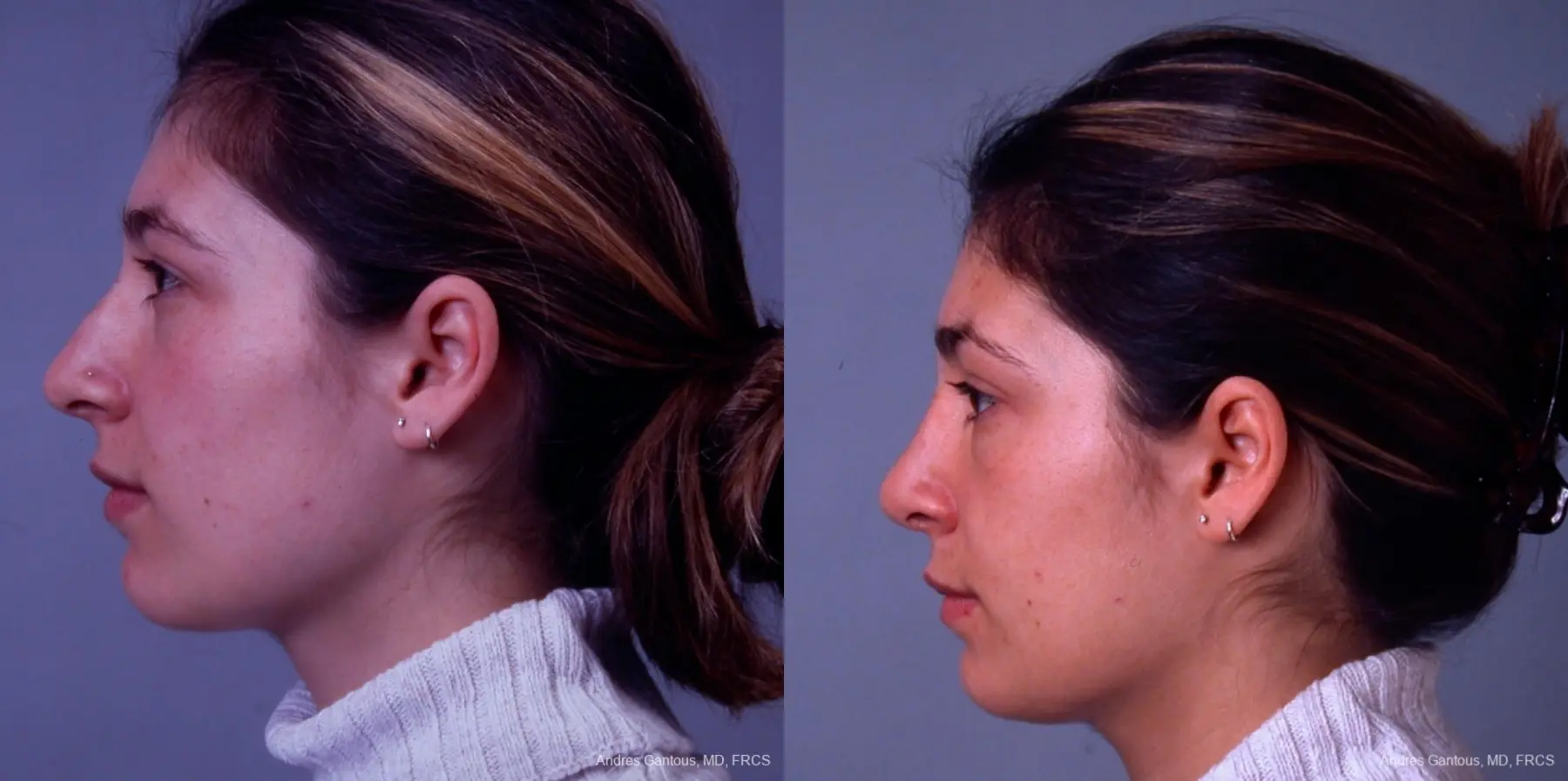 Rhinoplasty: Patient 32 - Before and After 4