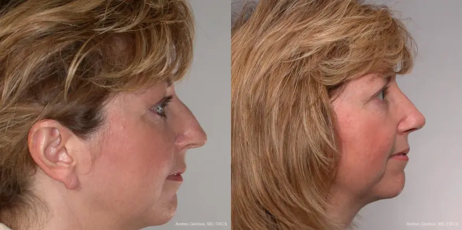Rhinoplasty: Patient 35 - Before and After 2