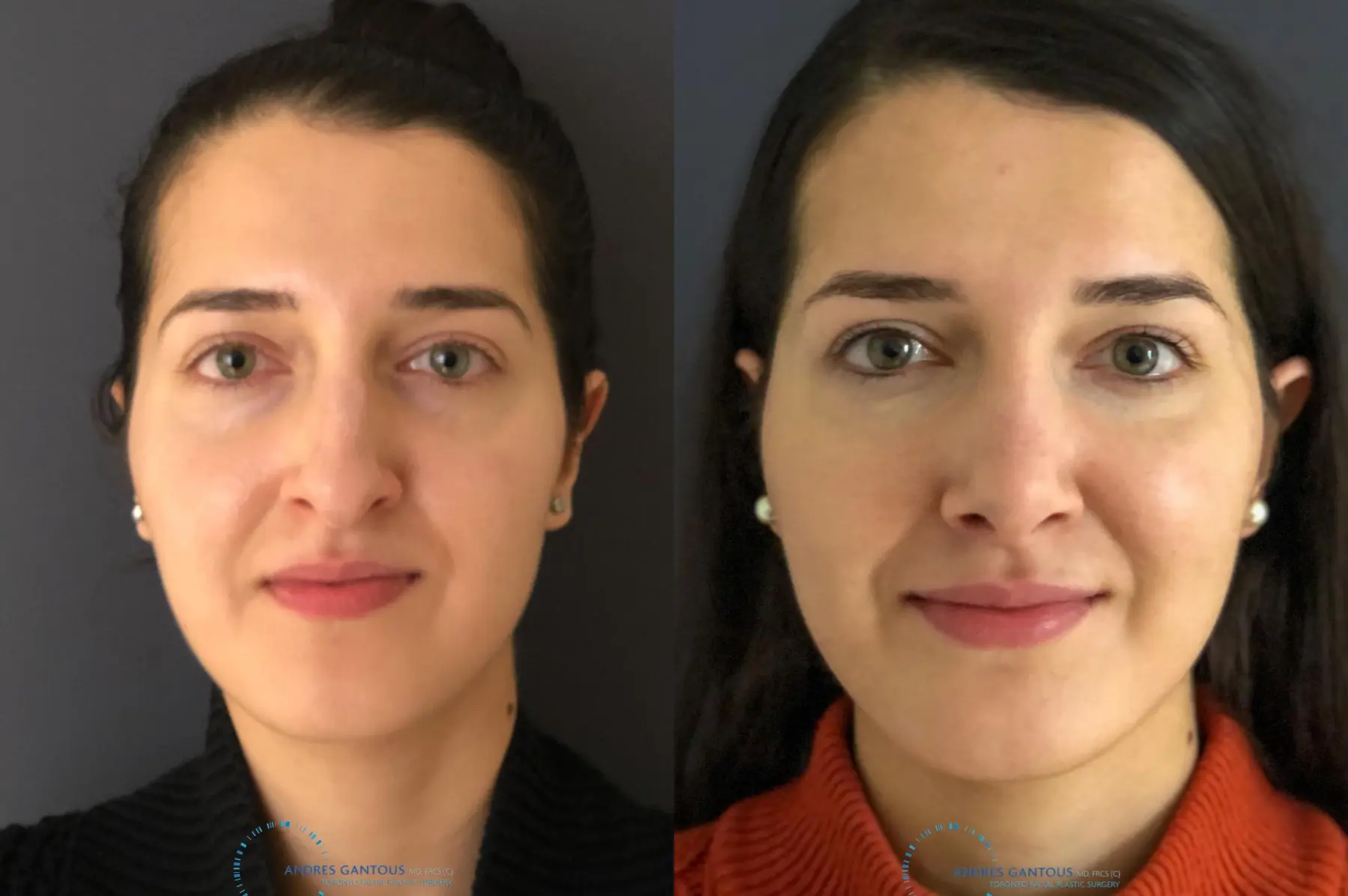 Rhinoplasty: Patient 9 - Before and After  