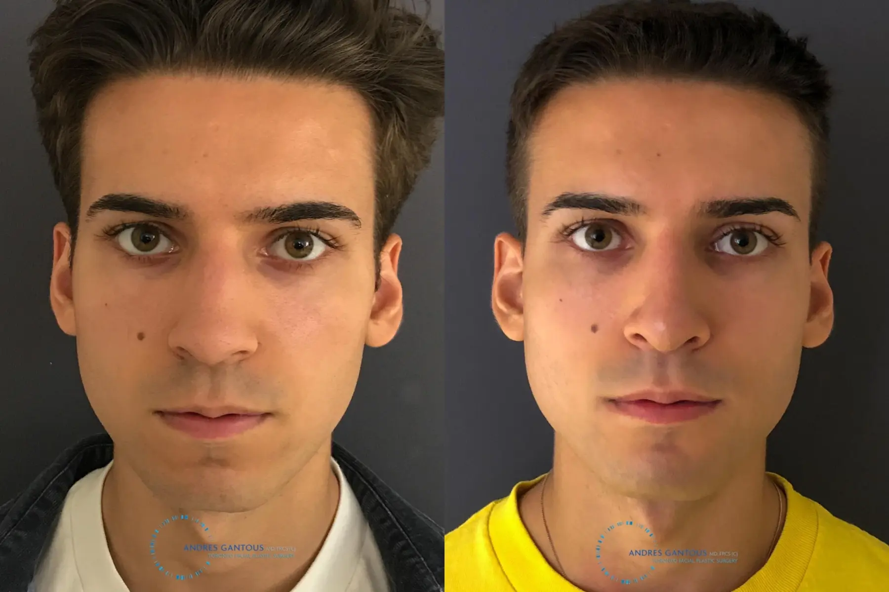 Rhinoplasty: Patient 63 - Before and After  