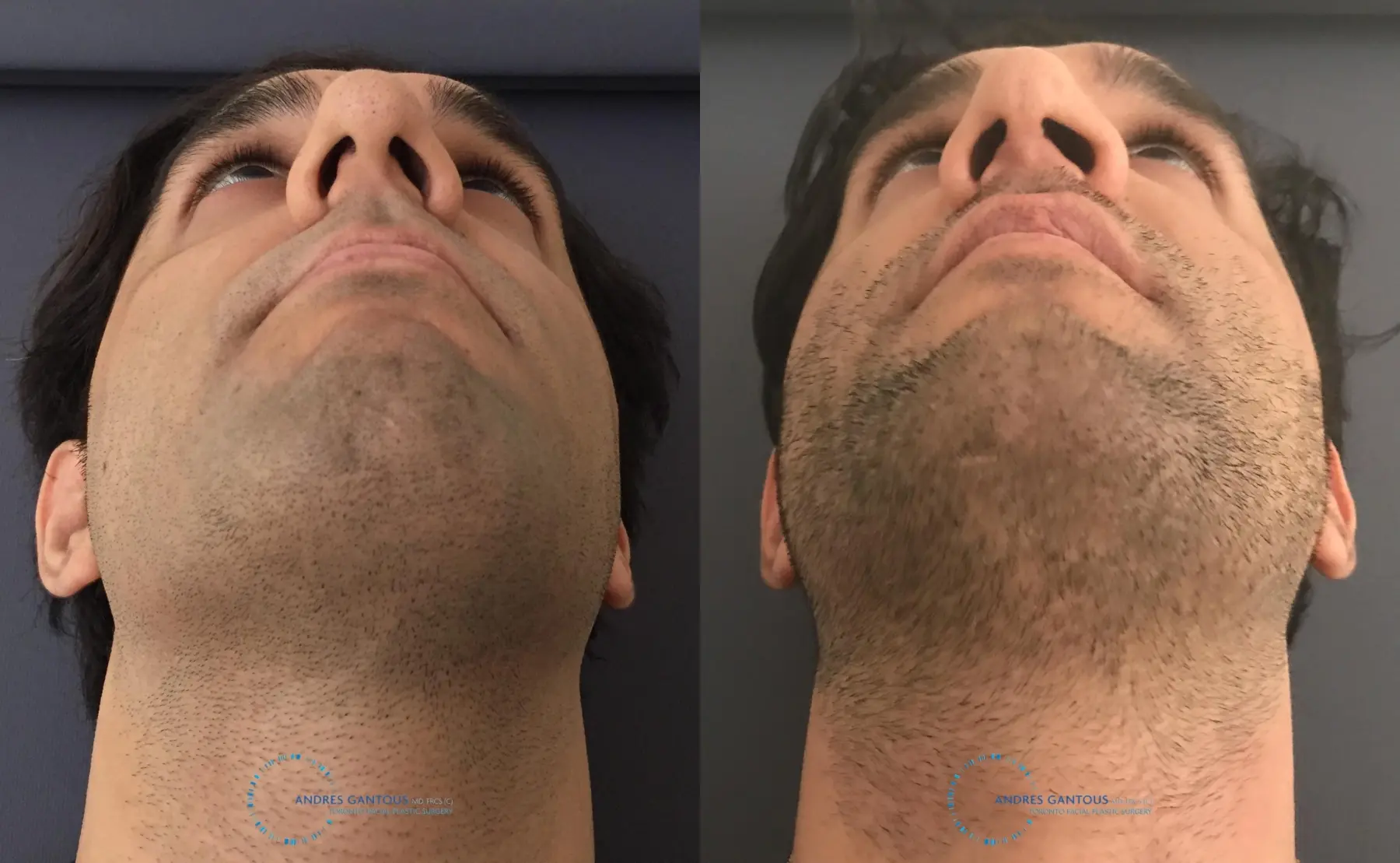 Rhinoplasty: Patient 60 - Before and After 2