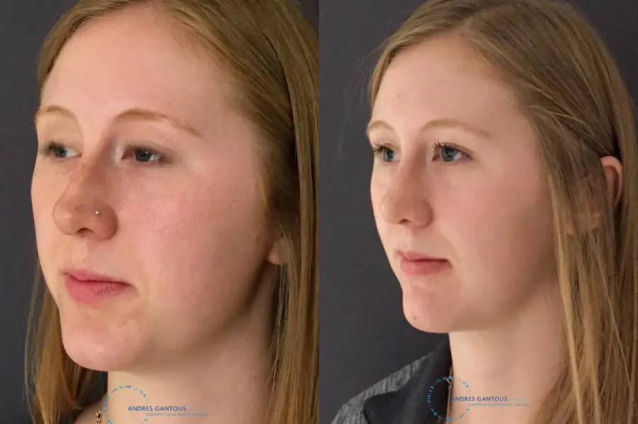 Rhinoplasty: Patient 26 - Before and After 3