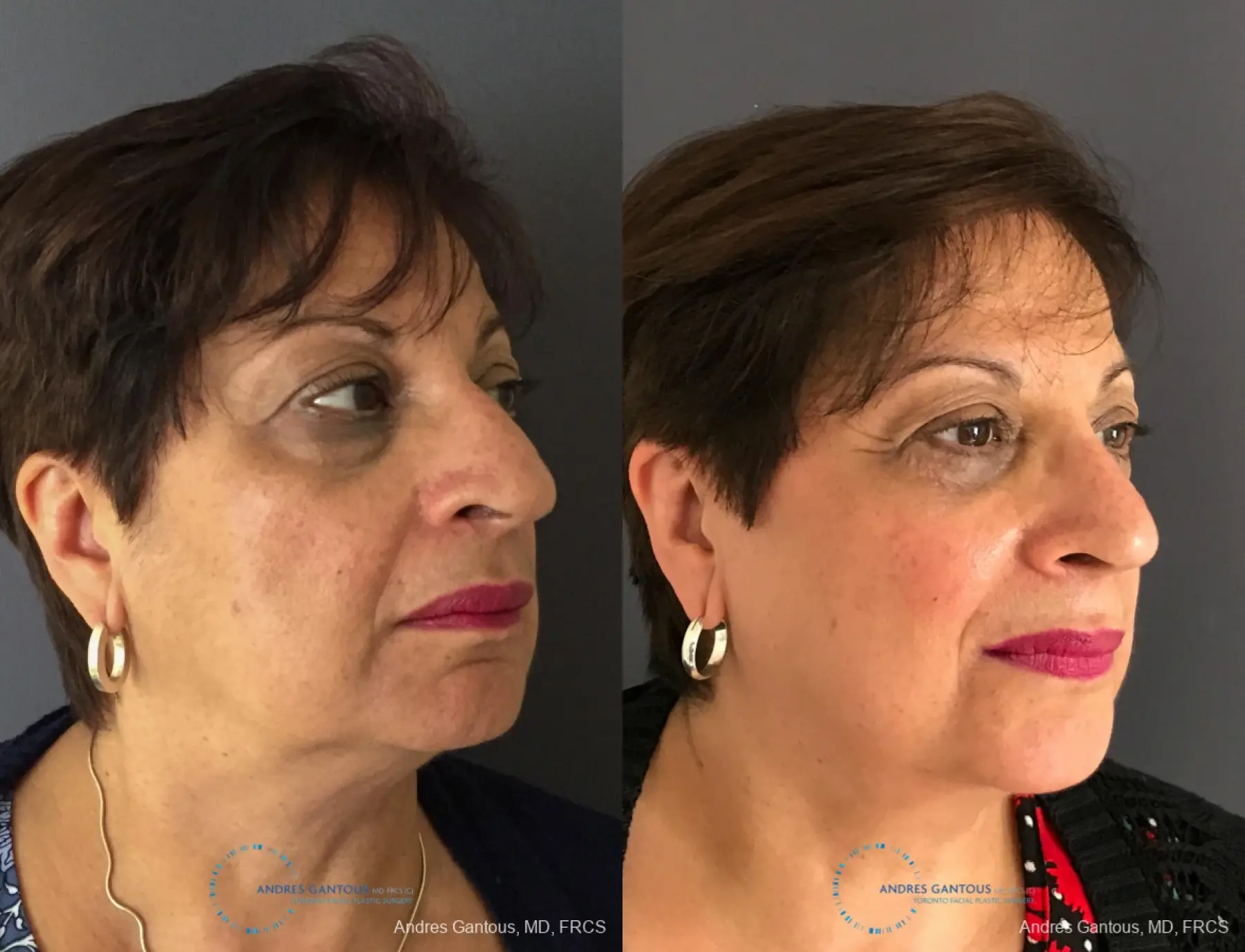 Rhinoplasty: Patient 91 - Before and After 3