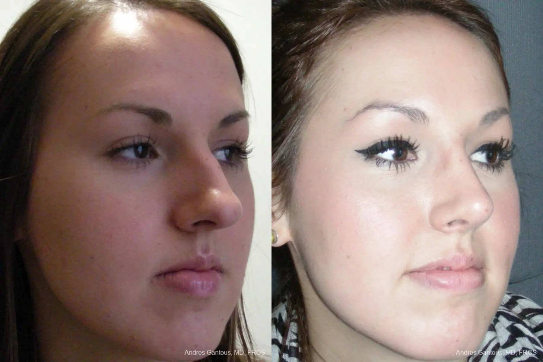 Rhinoplasty: Patient 21 - Before and After 2