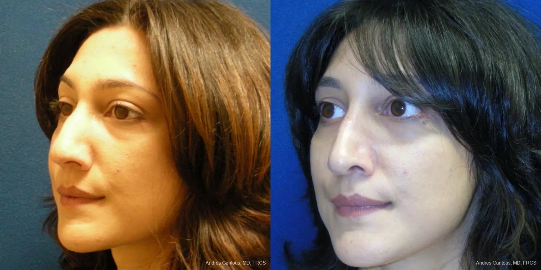 Rhinoplasty: Patient 42 - Before and After 3