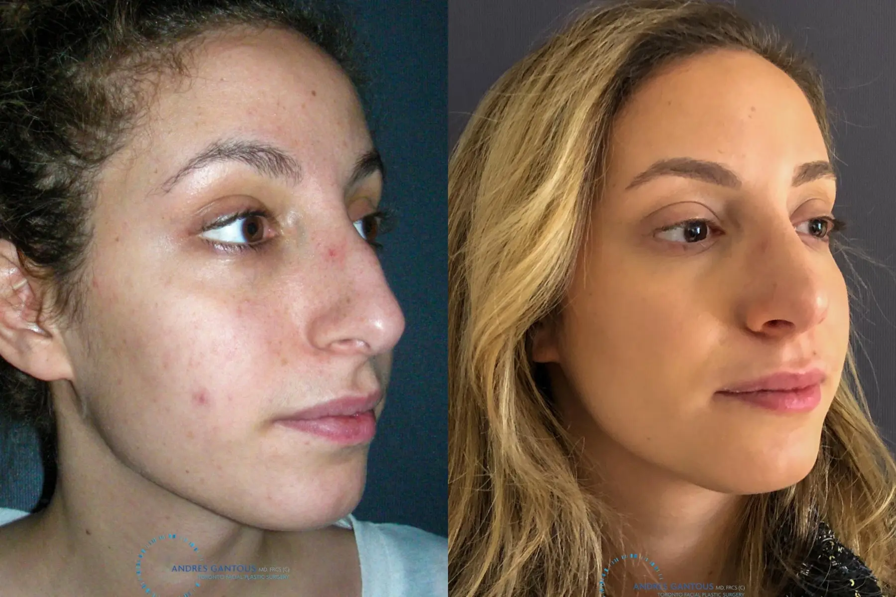 Rhinoplasty: Patient 72 - Before and After 3