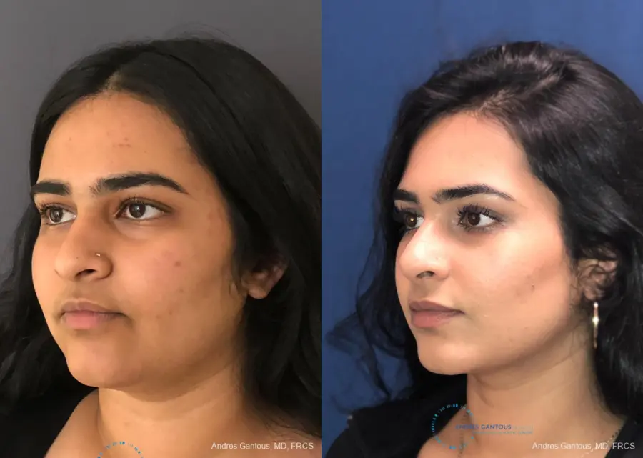 Rhinoplasty: Patient 86 - Before and After 4