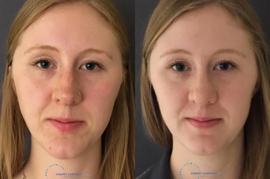 Rhinoplasty: Patient 26 - Before and After 1