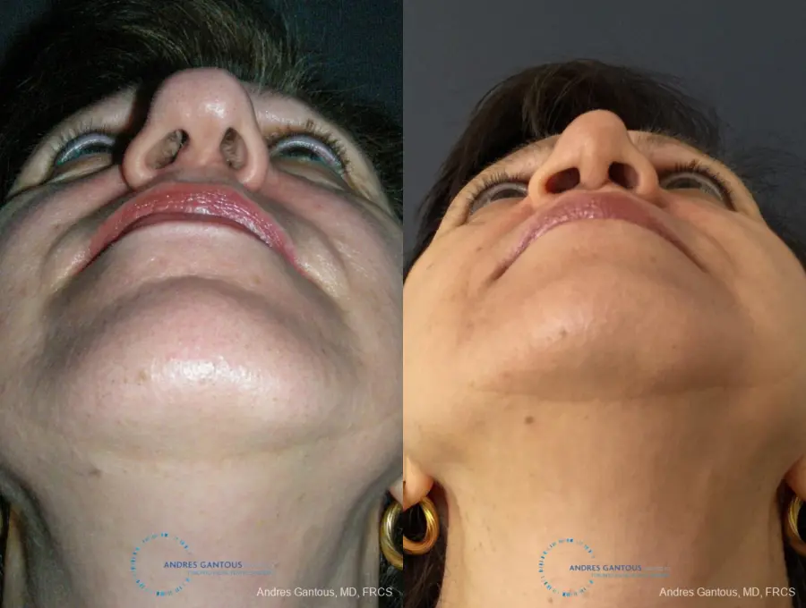 Rhinoplasty: Patient 95 - Before and After 2