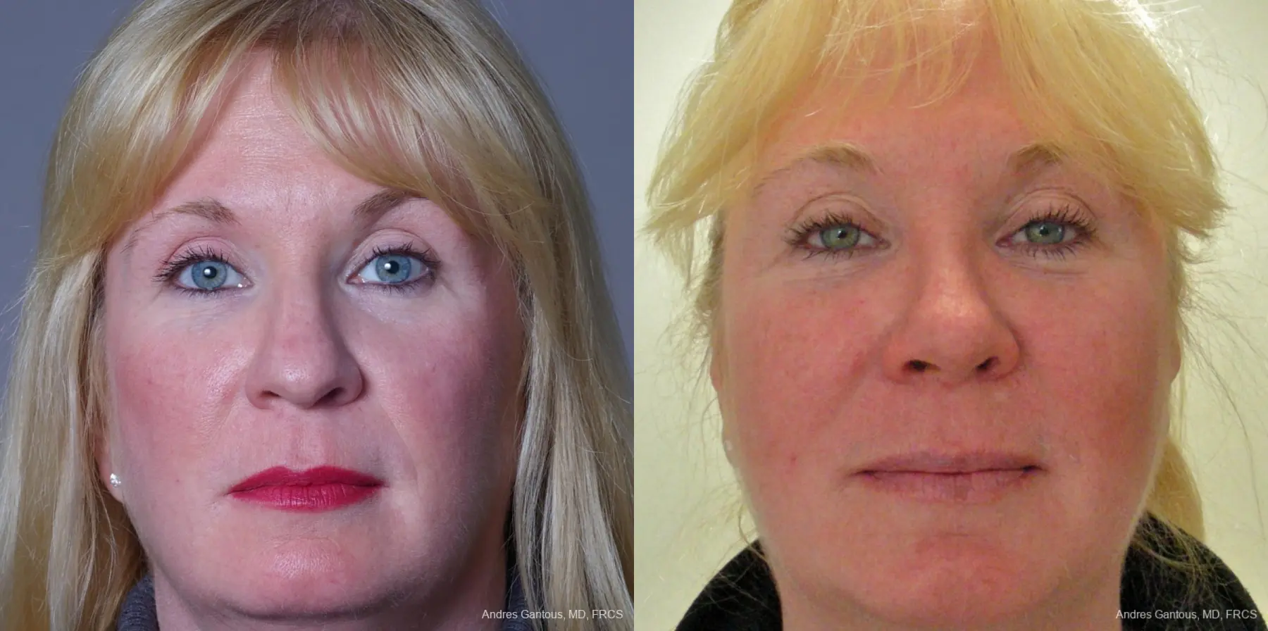 Rhinoplasty: Patient 37 - Before and After  