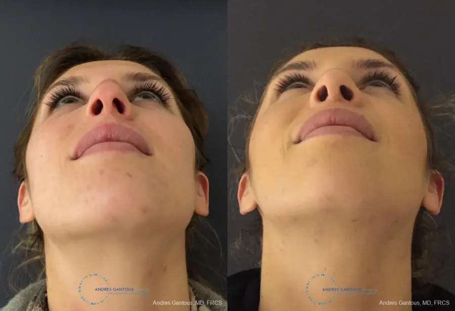 Rhinoplasty: Patient 79 - Before and After 2