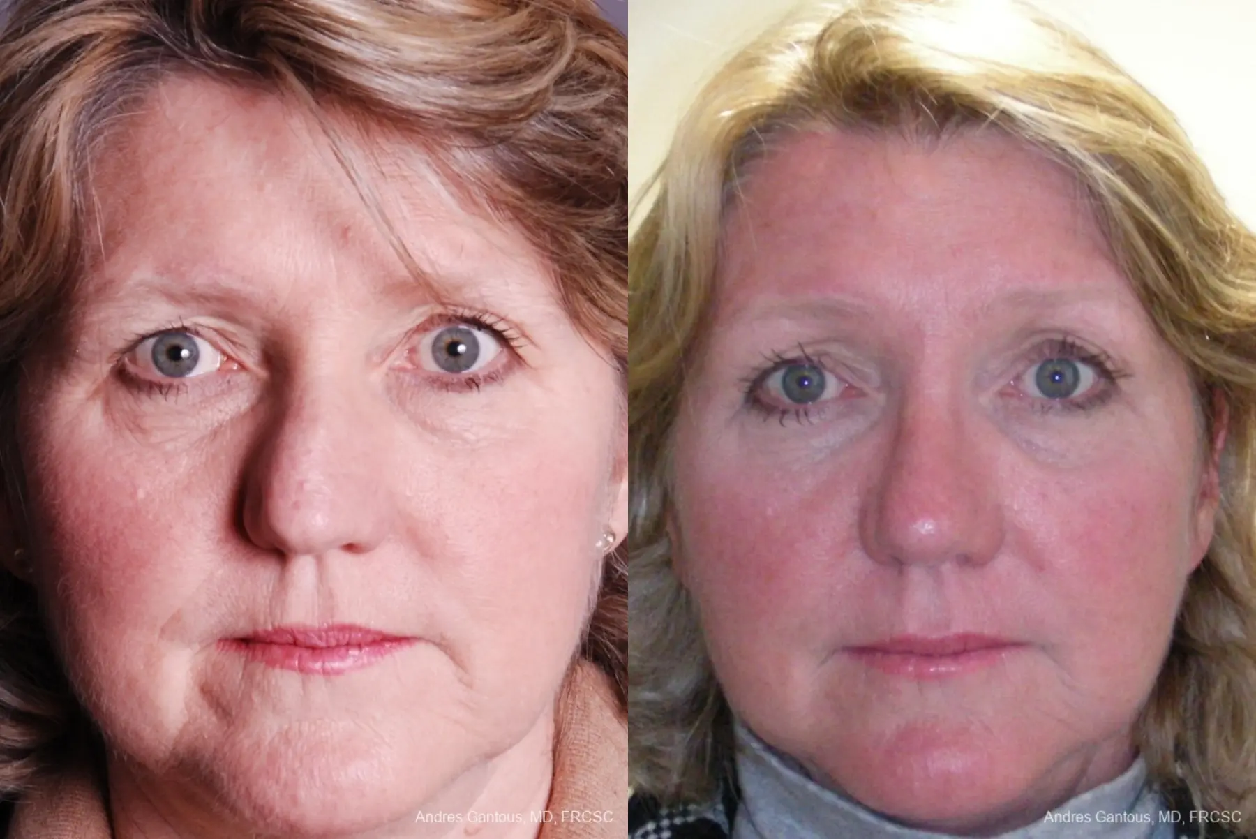 Rhinoplasty: Patient 18 - Before and After  