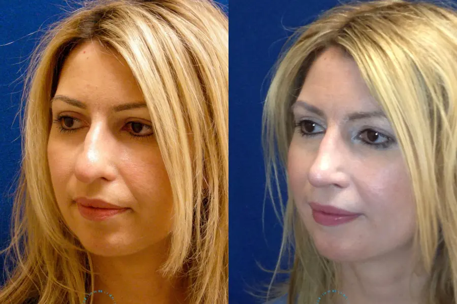 Rhinoplasty: Patient 74 - Before and After 2