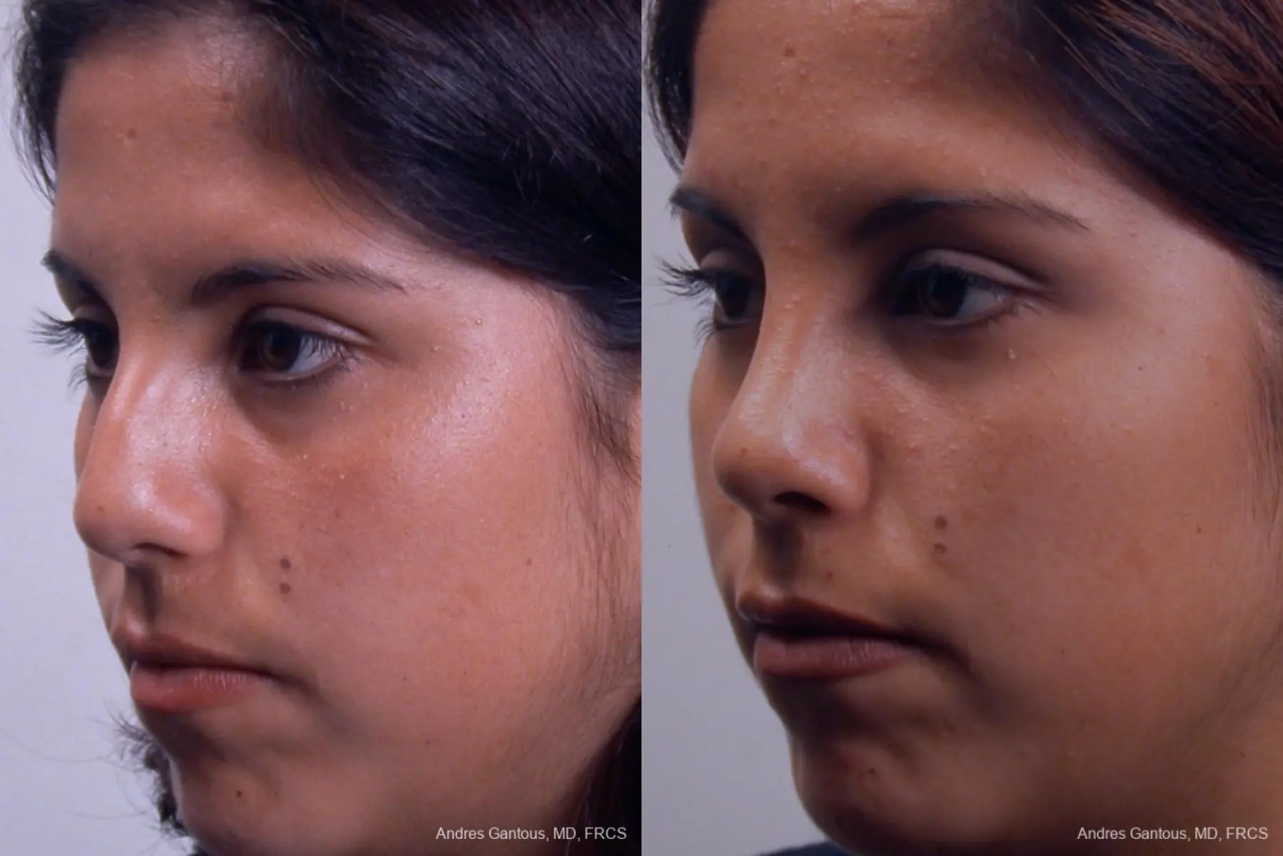 Rhinoplasty: Patient 19 - Before and After 3