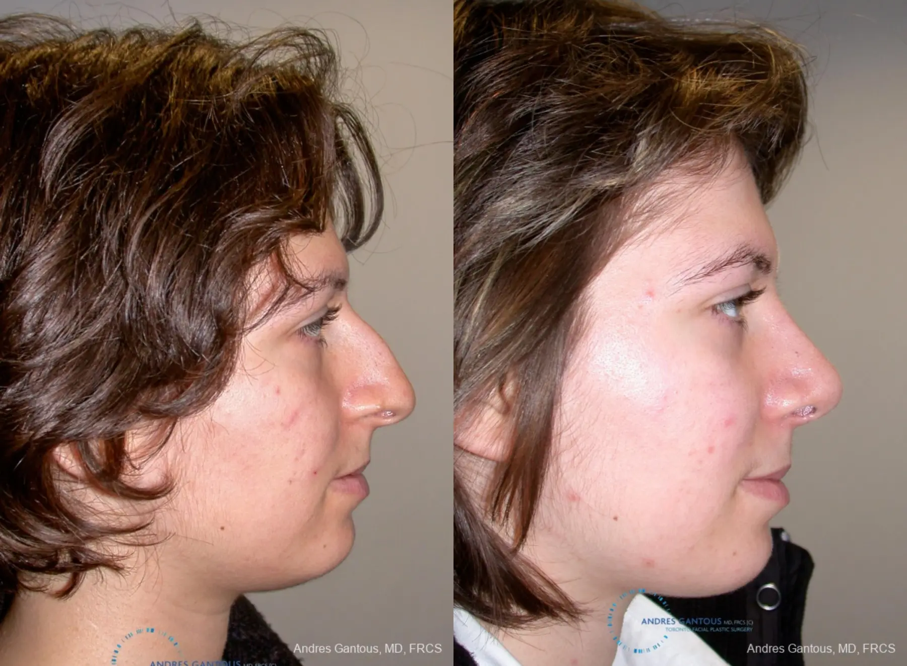 Rhinoplasty: Patient 90 - Before and After 4